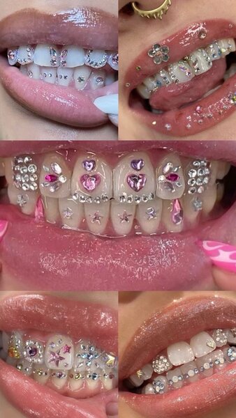 Strass dentaire