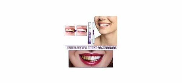 Smilekit Correcteur de Dents