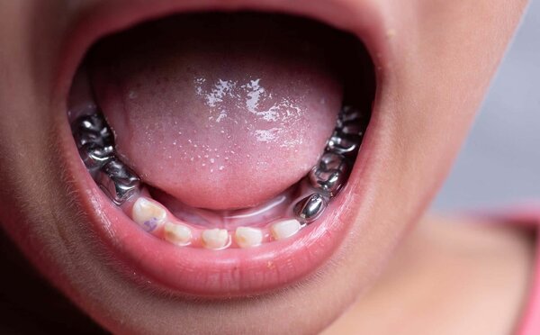 Silver tooth crown
