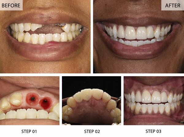 Tooth implant