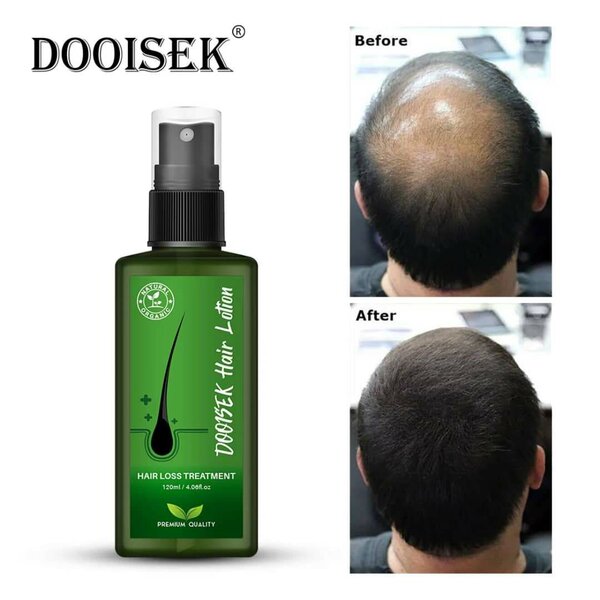 Lotion Anti-Chute Cheveux Efficace
