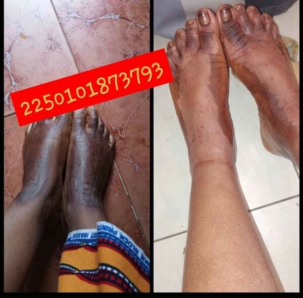 Huile peeling
