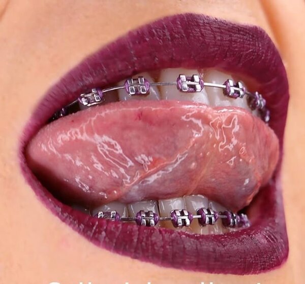Élastiques orthodontiques colorés