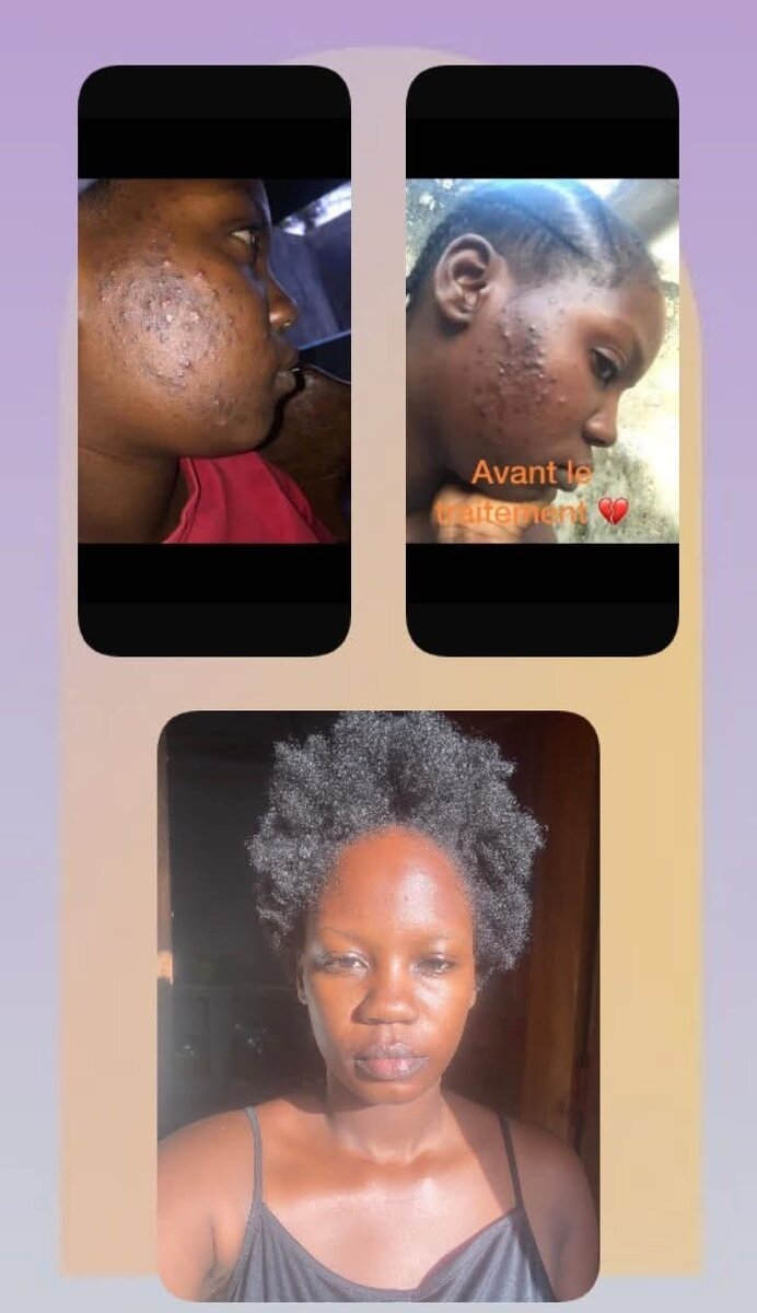 Gommage anti imperfections
