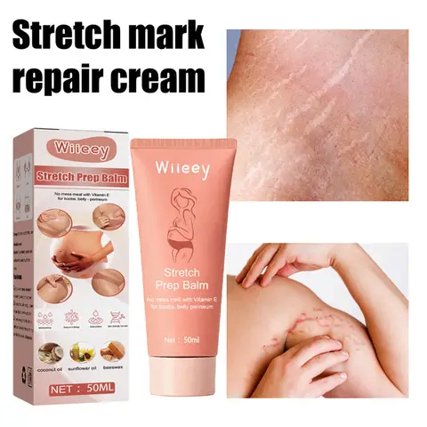 Crème anti-Vergetures