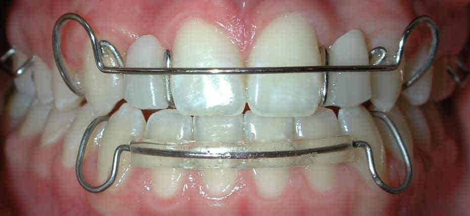 Retainers