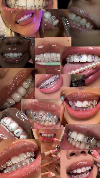 Tooth gems