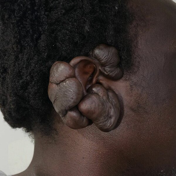 Lotion Keloid