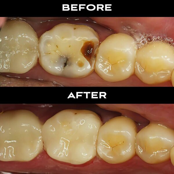 Composite Filling
