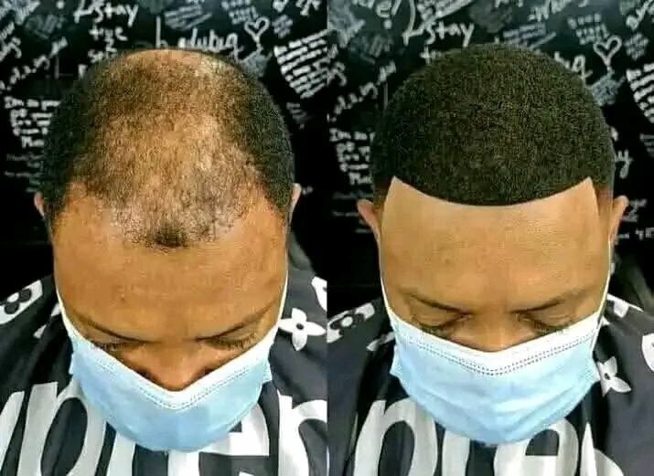 MINOXIDIL SPRAY