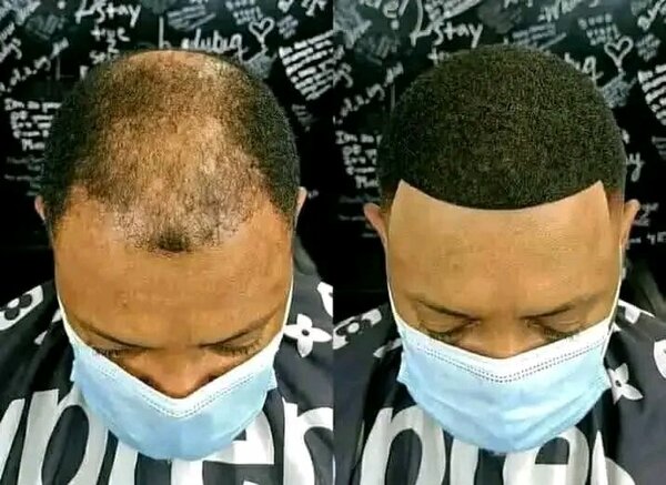 MINOXIDIL SPRAY