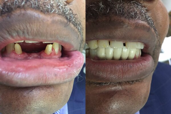 Zirconia crown