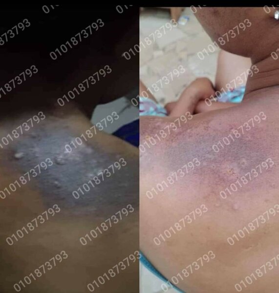 Huile peeling