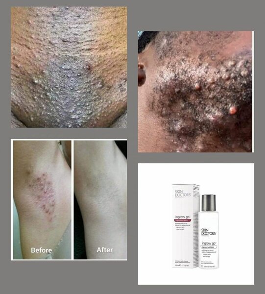 LOTION SKIN DOCTOR INGROW GO