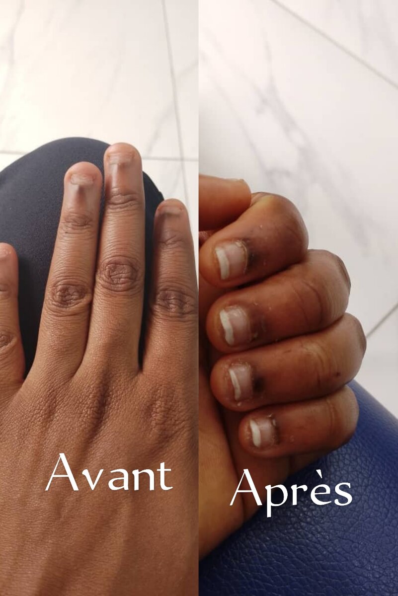 Vernis thérapeutique