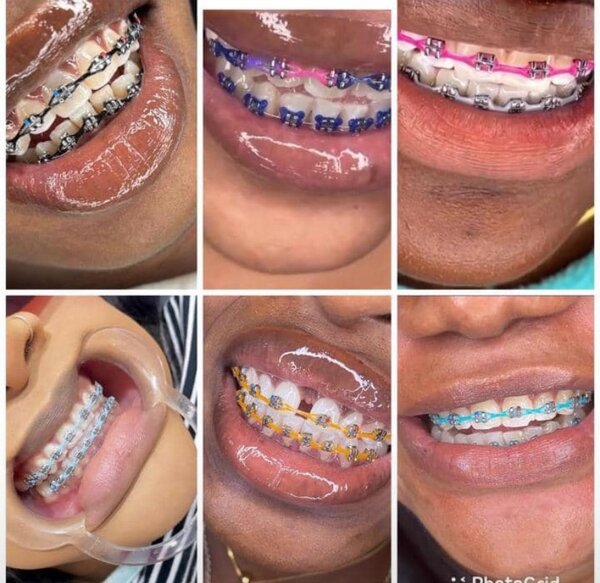 Fashionable Braces