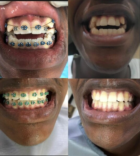 Braces