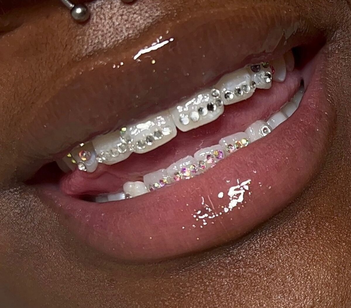 Tooth gems