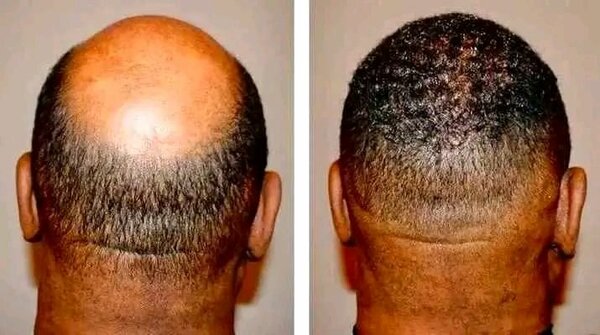 MINOXIDIL SPRAY