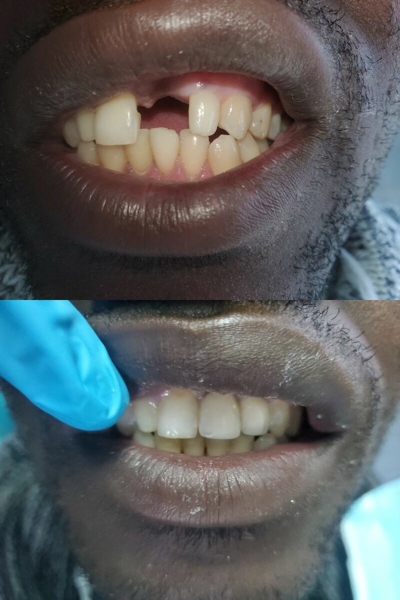 Zirconia crown
