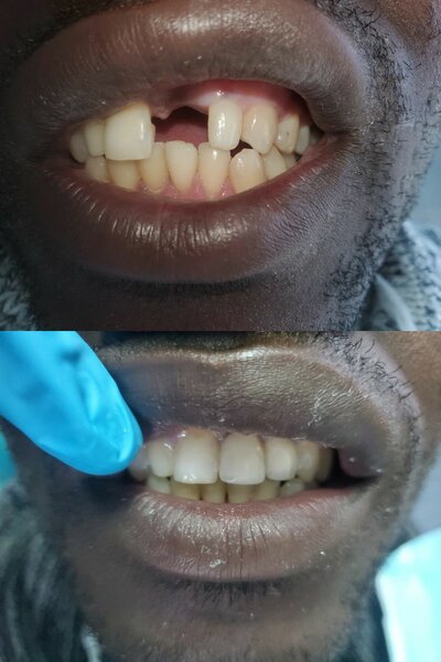 Zirconia crown