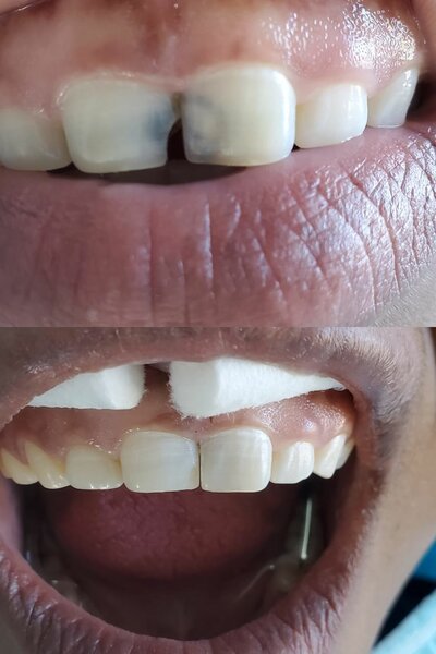 Composite Filling