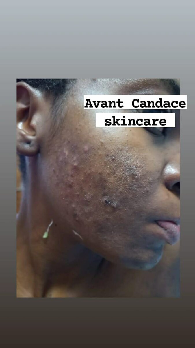 Pack anti imperfections