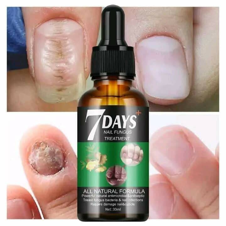 Traitement Antifongique Ongles Naturel