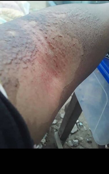 Huile peeling