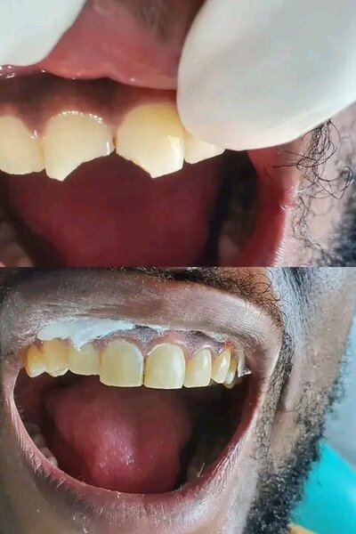 Composite Filling