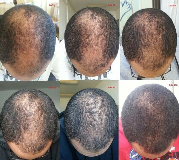 Rogaine Minoxidil Solution Box