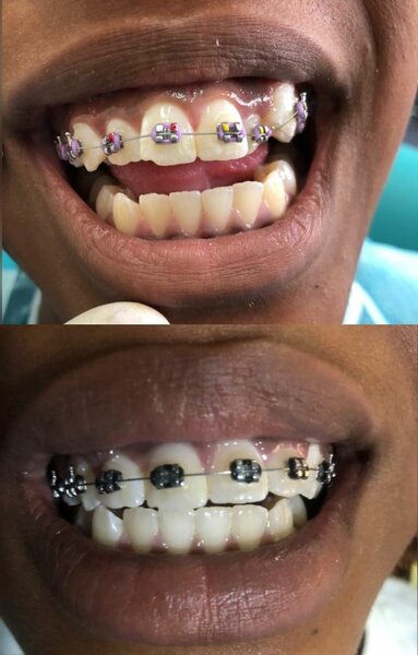 Braces
