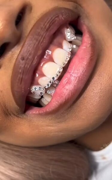 Strass dentaire