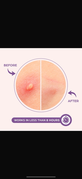 Pimple patches