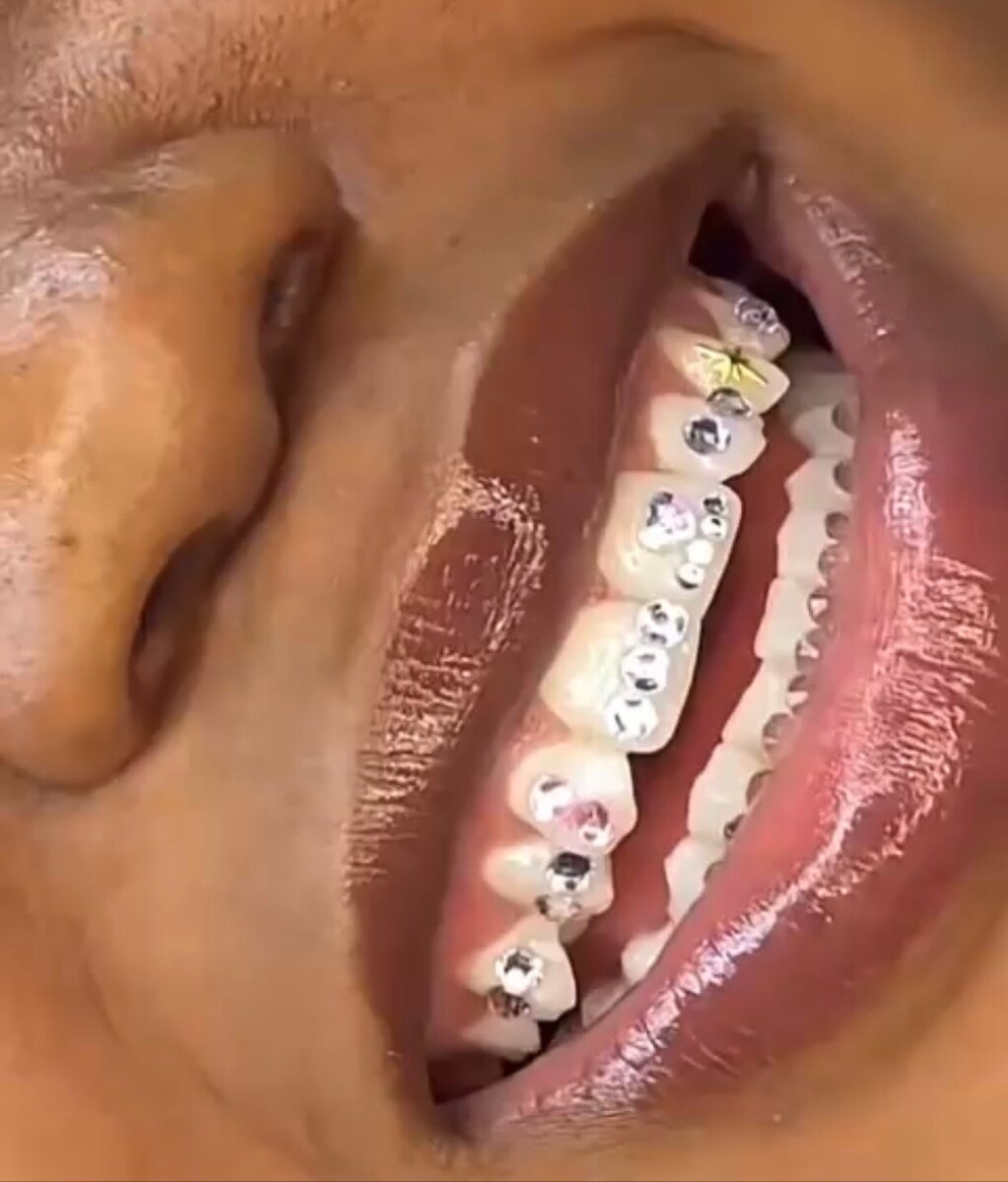 Tooth gem