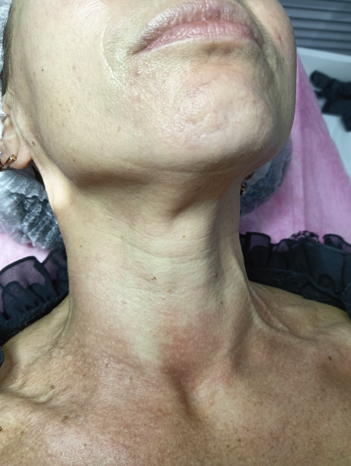 на шее кольца венеры, пластика шеи, холодная плазма кольца венеры, нити в шею, подтяжка шеи