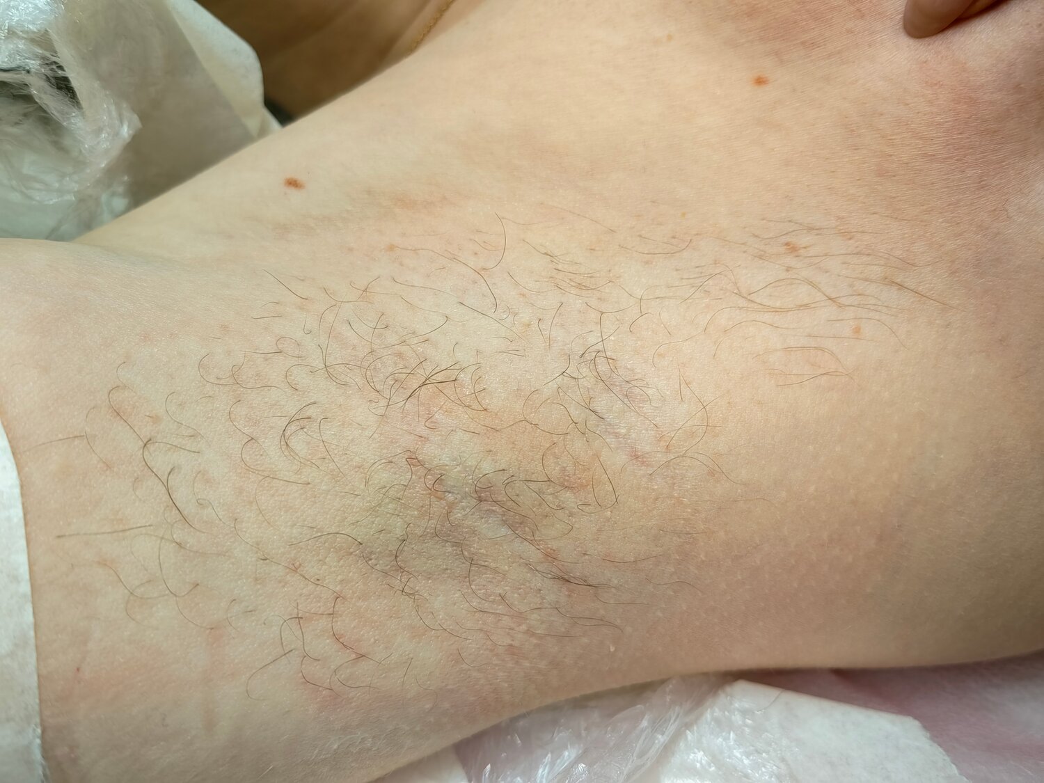 шугаринг депиляция, восковая депиляция, депиляция, электроэпиляция, сосудистые звездочки на ногах