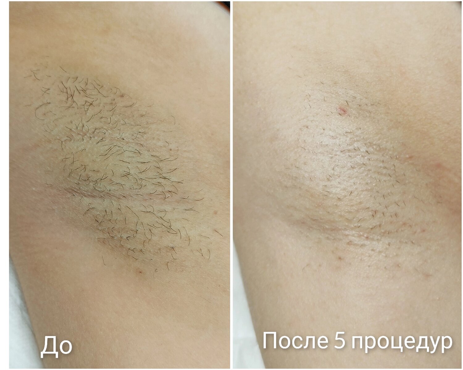 лазерная эпиляция, эпиляция, после лазерной эпиляции, результаты лазерной эпиляции, эпиляция воском
