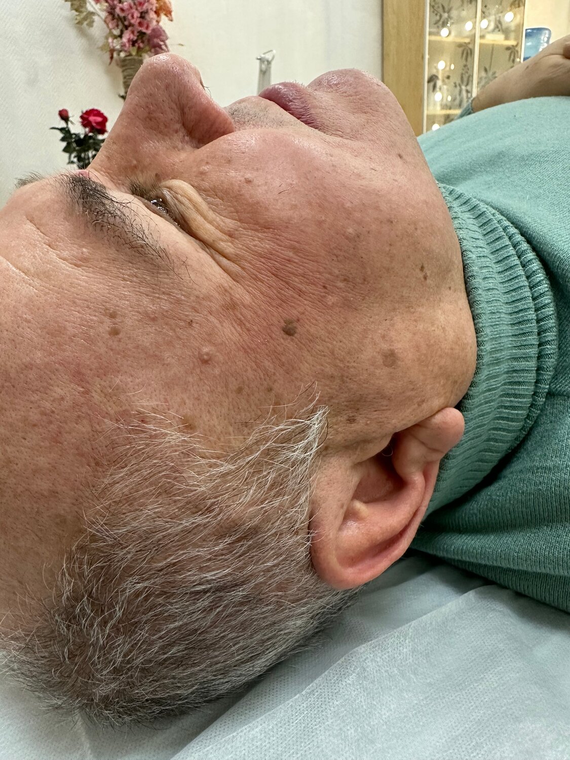 пилинг, человек, пилинг тса, лицо, омоложение