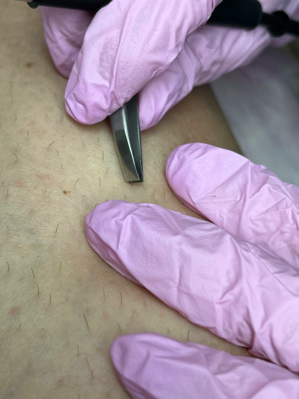 электроэпиляция, электроэпиляция аппарат, аппарат электроэпиляции, электроэпиляция в москве, электроэпиляция зоны бикини