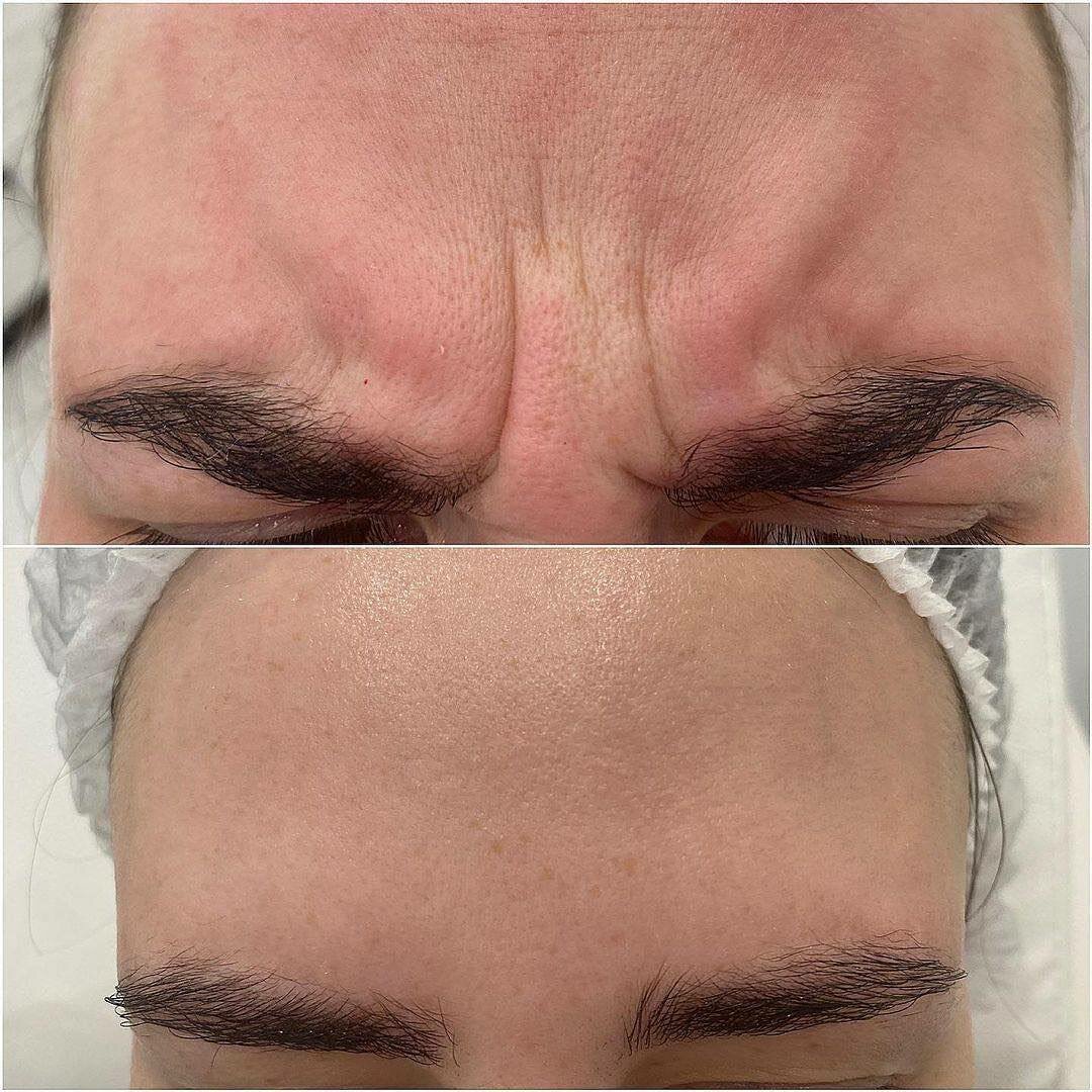 межбровье, ботокс межбровье, ботокс межбровка, межбровка, ботокс в лоб