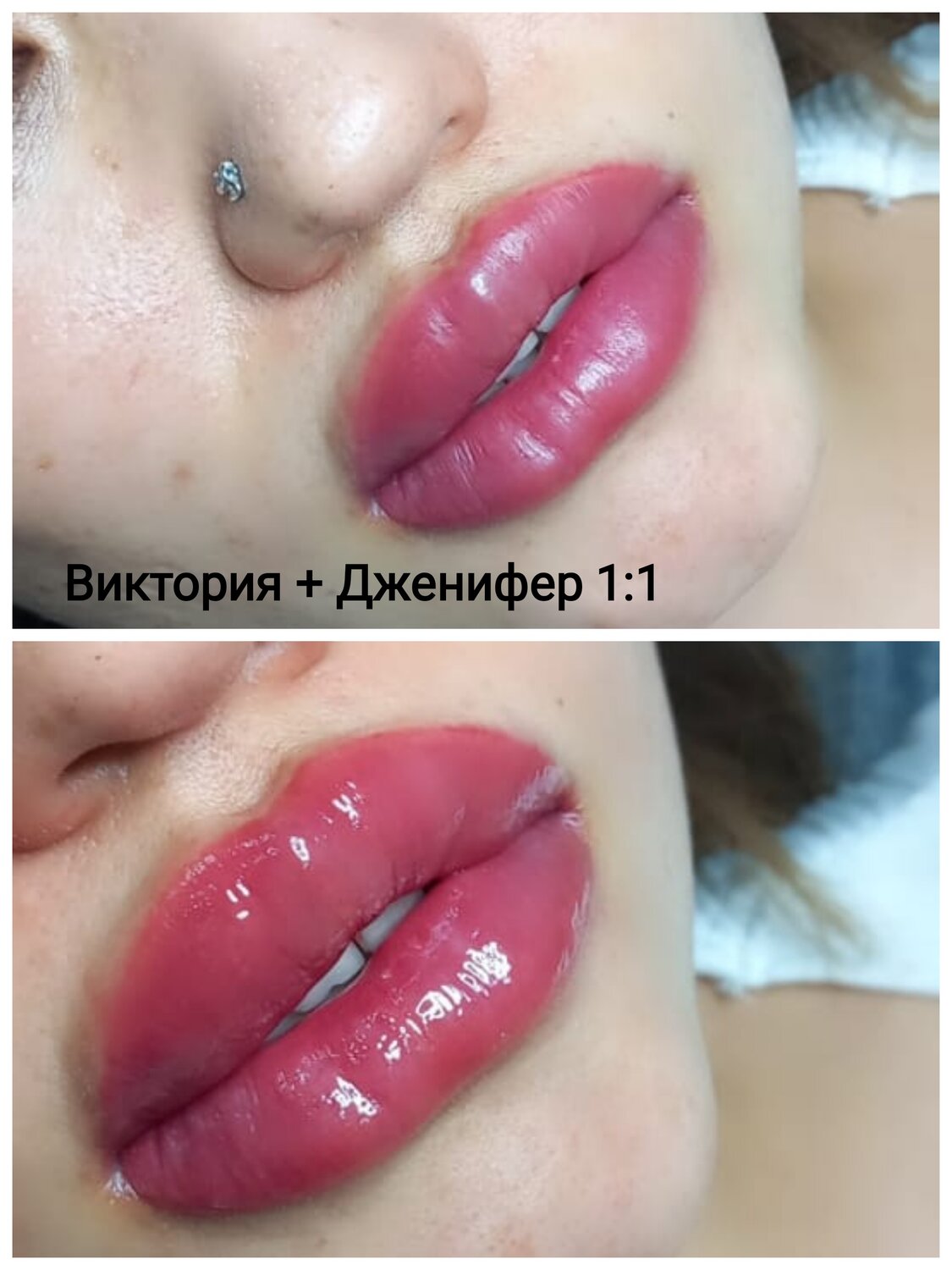 увеличение губ, гиалуроновая кислота губы, губы гиалуроновой, губы гиалуроновой кислотой, губы после увеличения