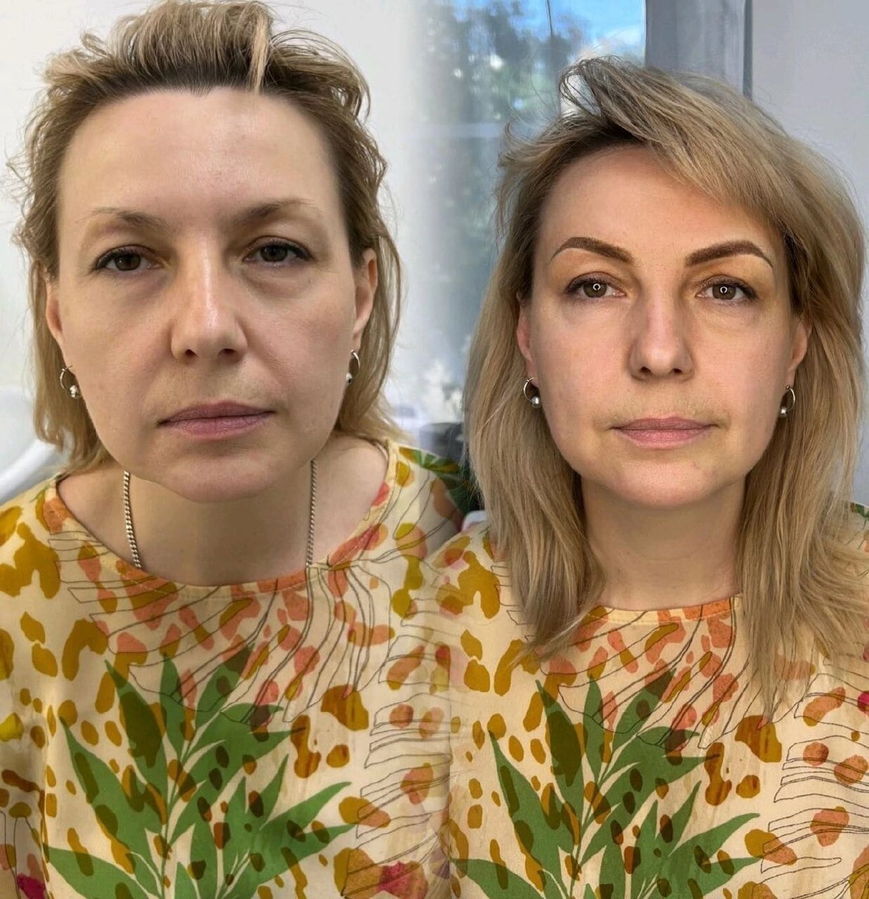 ботокс нижней трети лица, пластика лица, лифтинг лица, круговая подтяжка лица, коррекция нижней трети лица