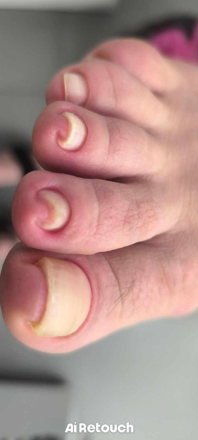 ноготь, врастает ноготь, toenail fungus, пальцы, ногти с грибком на ногах