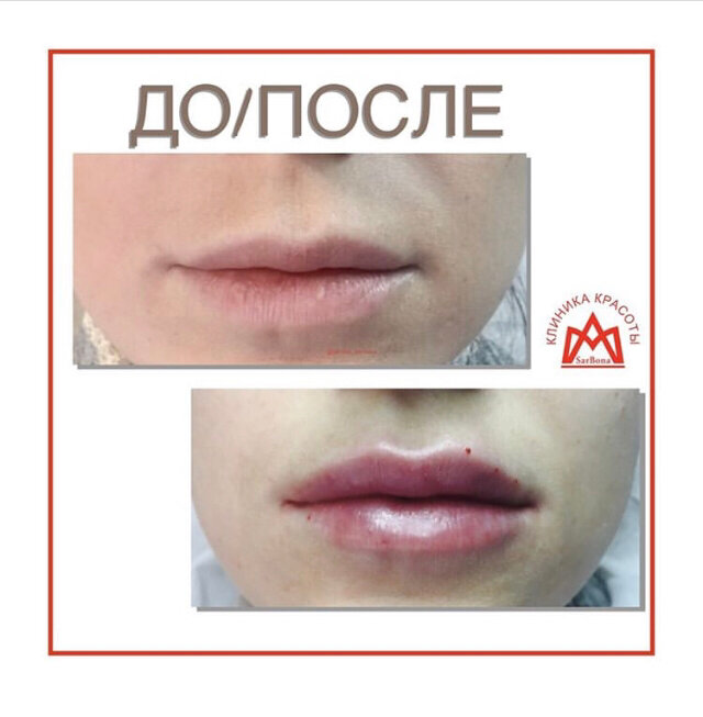 Увеличение губ