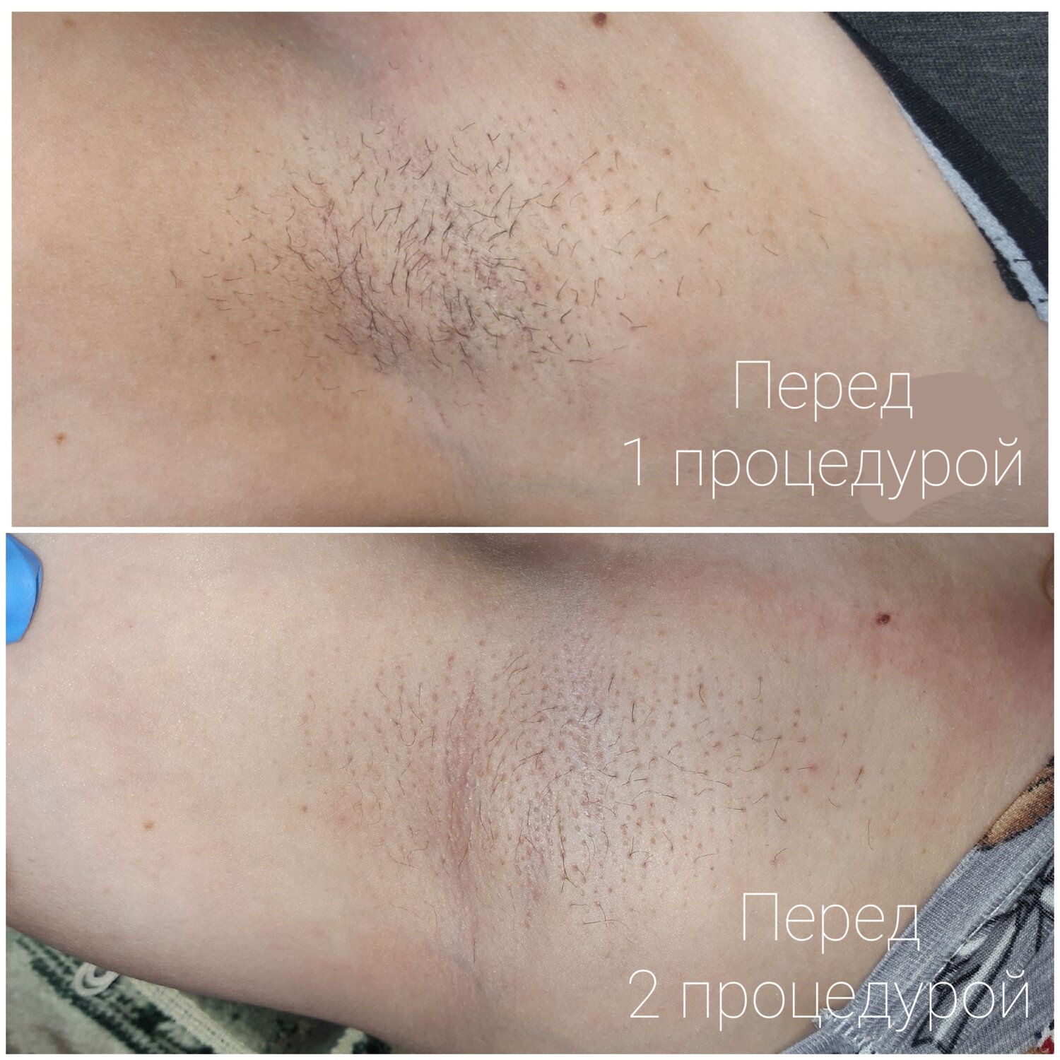 электроэпиляция, электроэпиляция глубокое бикини, эпиляция классическое бикини, электроэпиляция бикини глубокое тольятти, эпиляция глубокого бикини