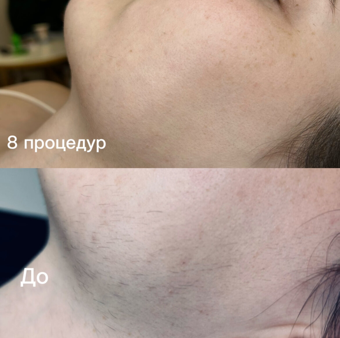 лазерная эпиляция лица, лазерная эпиляция, лазерная эпиляция лица для женщин, эпиляция диодным лазером, лазерная эпиляция волос