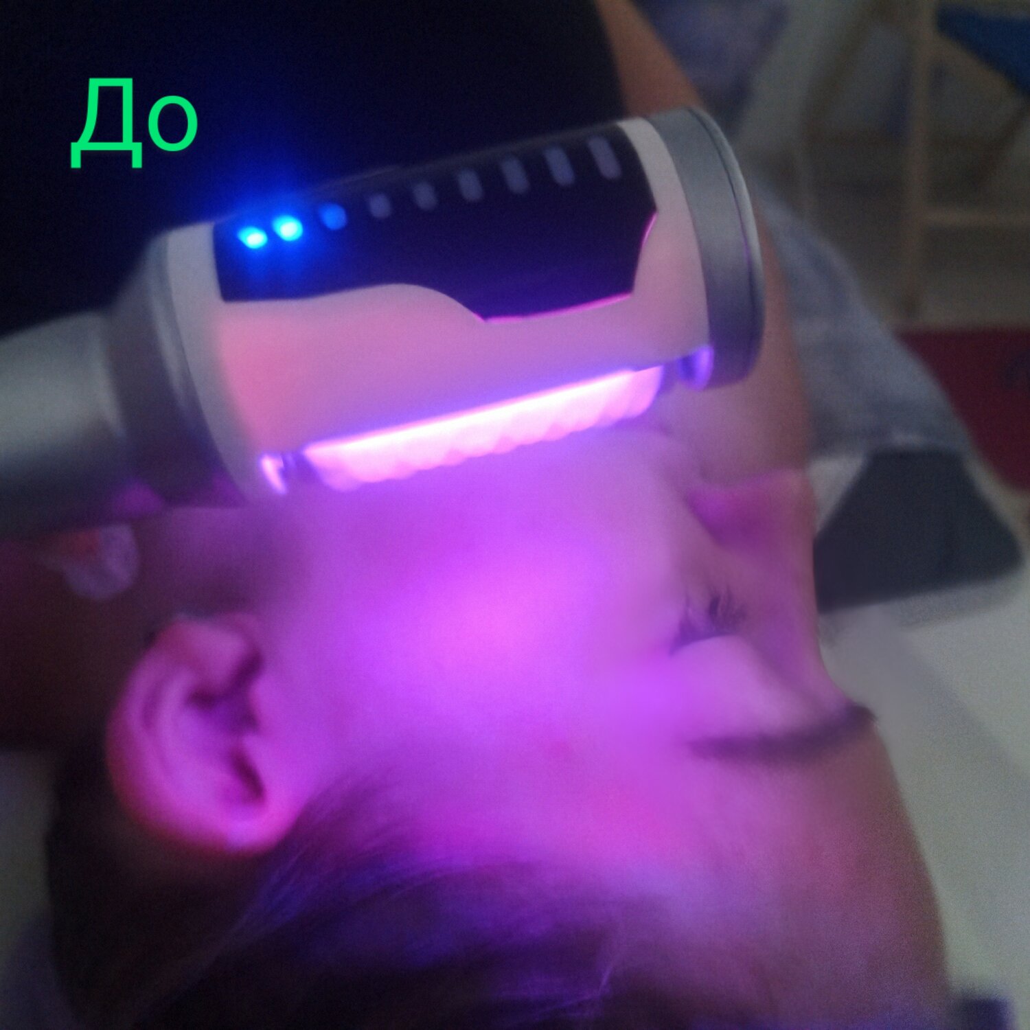 аппарат эндосфера, эндосфера аппарат для коррекции фигуры, эндосфера лица, лазерная косметология, эндосфера манипула