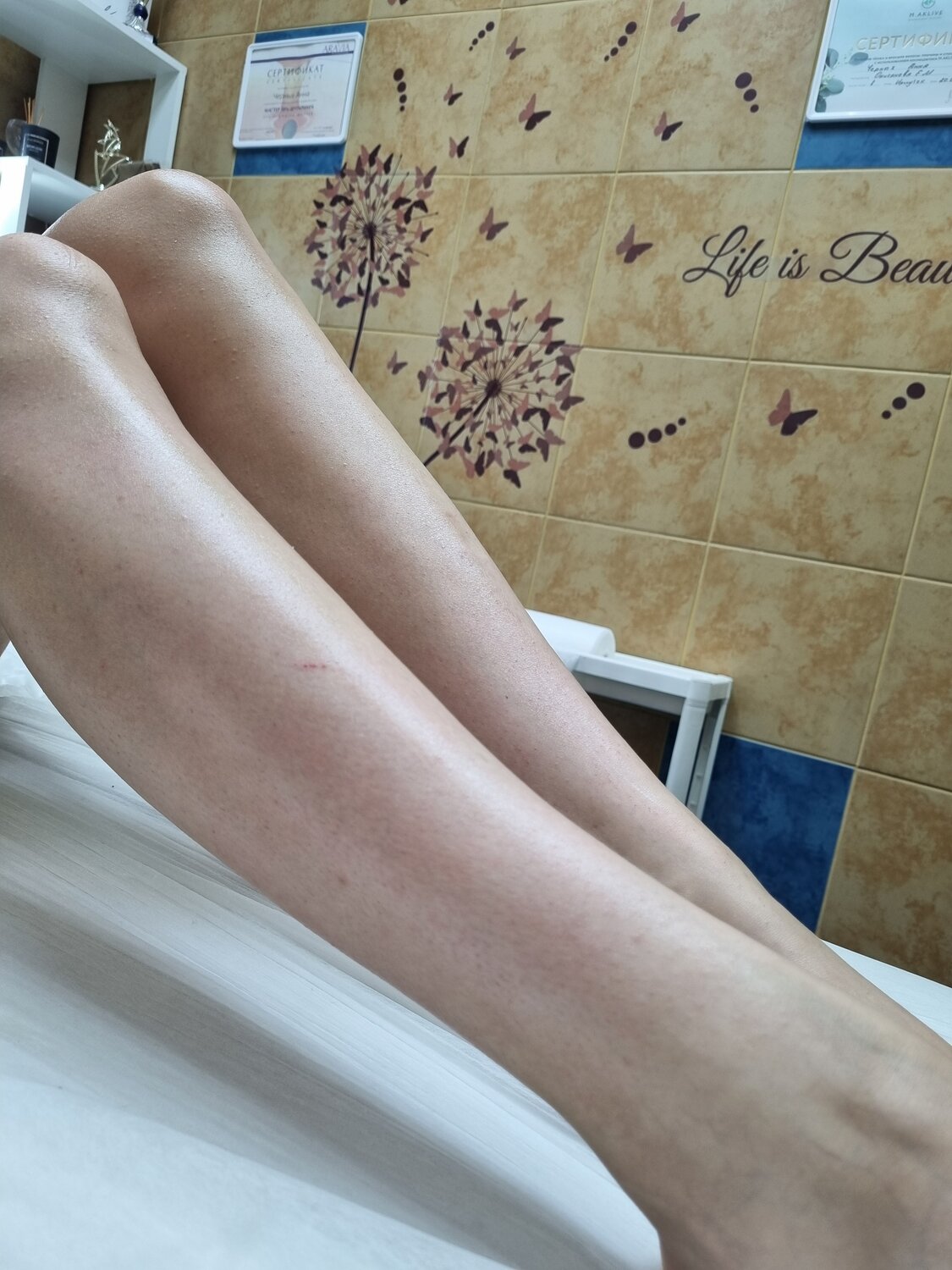 депиляция ног, голени лазерная эпиляция, депиляция голени, депиляции, эпиляция ног