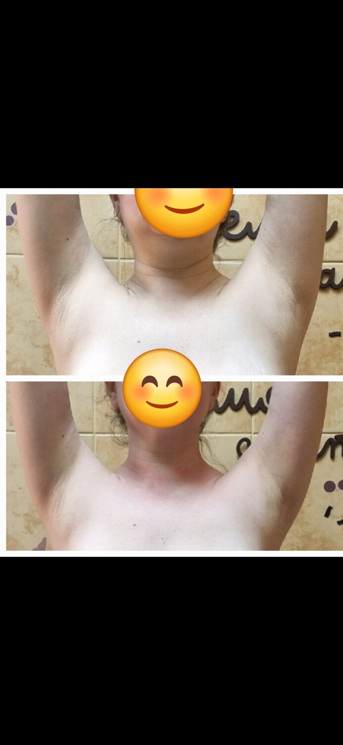 депиляция подмышек, ipl hair removal, депиляции, гладкие подмышки, подмышка
